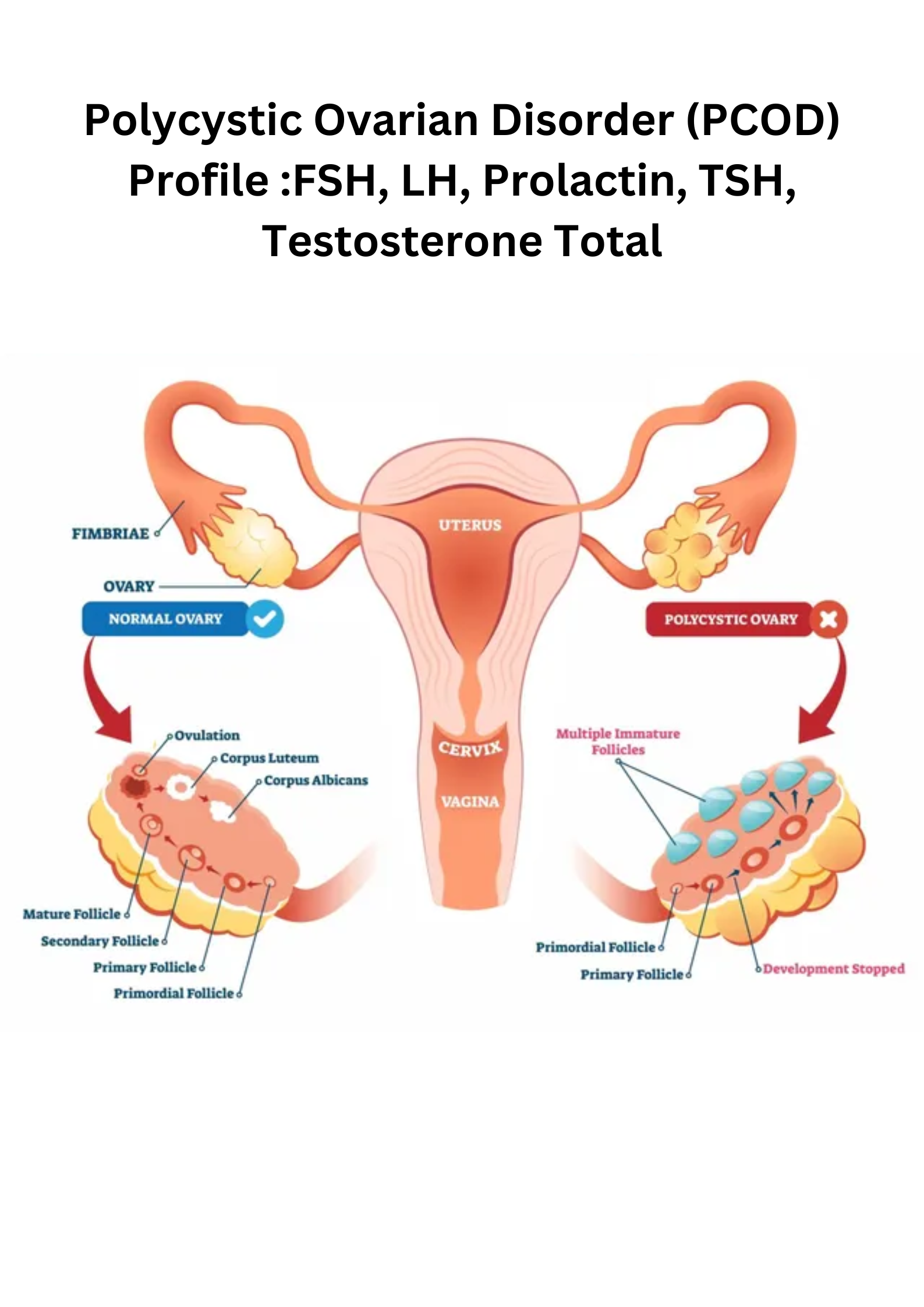Polycystic Ovarian Disorder (PCOD) Profile :FSH, LH, Prolactin, TSH, Testosterone Total